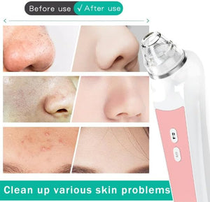 3-in-1 Blackhead Remover Vacuum with Camera kit, 6 Blackhead Extractor &amp; Probes, USB Rechargeable Blackhead Suction Remover, Pore Vacuum Tool, 3 Charcoal Masks &amp; 144 Acne Patches, (Pink)