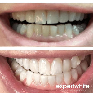 16% Carbamide Teeth Whitening Gel Made in The USA for Sensitive Teeth (4 gels, 3cc Each). The Best Gel for Bright White Teeth is Used with Any Trays.