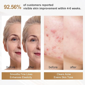 Aphrona FDA cleared LED Facial Skin Care Mask -Blue &amp Red Light Treatment Photon Mask (Pearl)