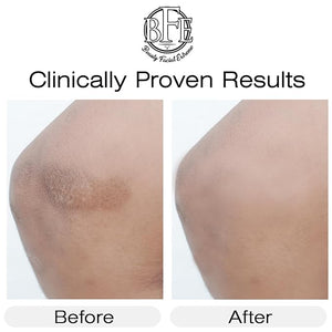 Vitamin K Cream- Moisturizing Bruise Healing Formula. Dark Spot Corrector for Bruising, Spider Veins &amp; Broken Capillaries. Reduces Under Eye Dark Circles, Fine Lines, Puffiness, &amp; Wrinkles.