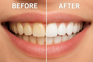 ¡°Teeth Whitening Strips for Sensitive Teeth ? Fast 7-Day Results, Coconut &amp; Mint Natural Formula, 28 Strips (14 Treatments)¡±