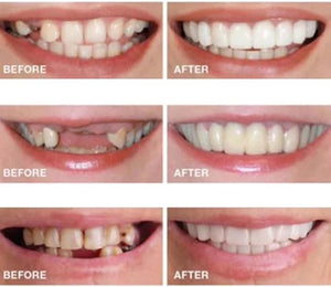 2 Pairs Nature and Comfortable to Regain Confident Smile, Top and Bottom (1)