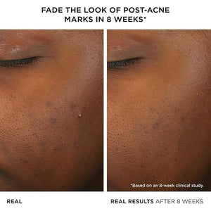 IT Cosmetics Bye Bye Breakout Acne Treatment Face Serum -With 2% Salicylic Acid &amp 3% Lactic Acid - Helps Reduce Pimples in 3 Days &amp Fades Look of Post-Acne Marks in 8 Weeks - 1 Fl. Oz