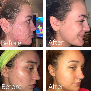 Dr Song Benzoyl Peroxide Wash 10% Acne Treatment: Acne Face Wash &amp; Body Wash (8 Fl Oz (Pack of 1))