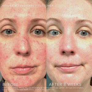 Rodan and Fields Soothe Regimen for Sensitive Irritated Skin and Facial Redness