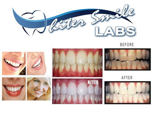 Professional Custom Teeth Whitening Tray Kit. Dental Lab Direct, Custom Made Teeth Whitening Tray, U.S.A Made Bleaching Trays with 38% High Intensity Gel Fast Results Custom Upper and Lower Trays