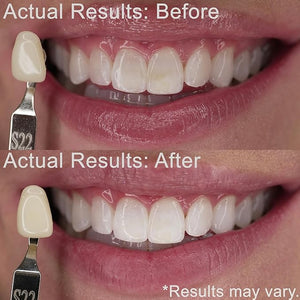 Teeth Whitening Kit | Fast Whitener Gel 44% Carbamide Peroxide | for Discolored, Yellow, Brown, Black, Coffee, Smoking, Intrinisic Deep Stains